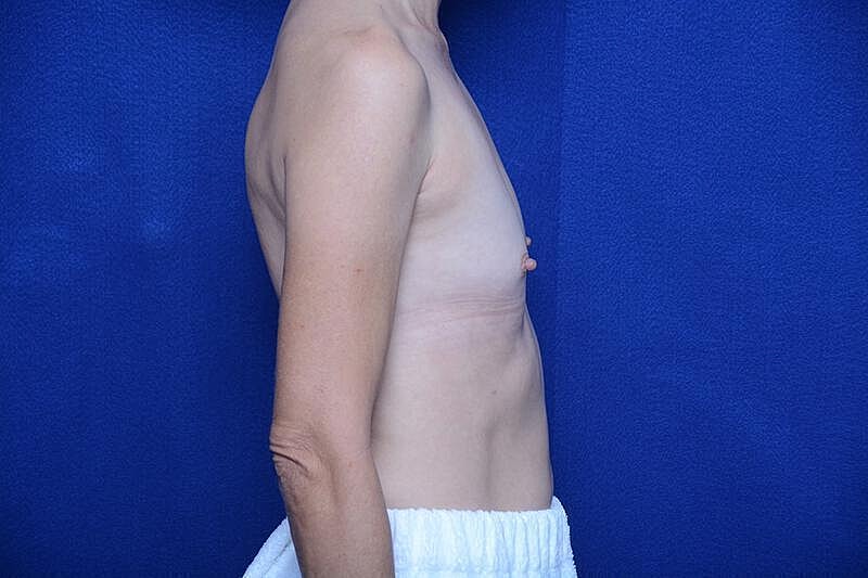 Breast Augmentation Before & After