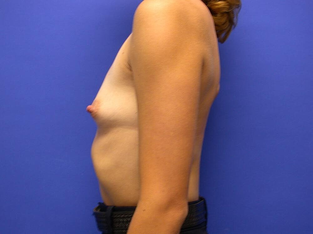 Breast Augmentation Before & After
