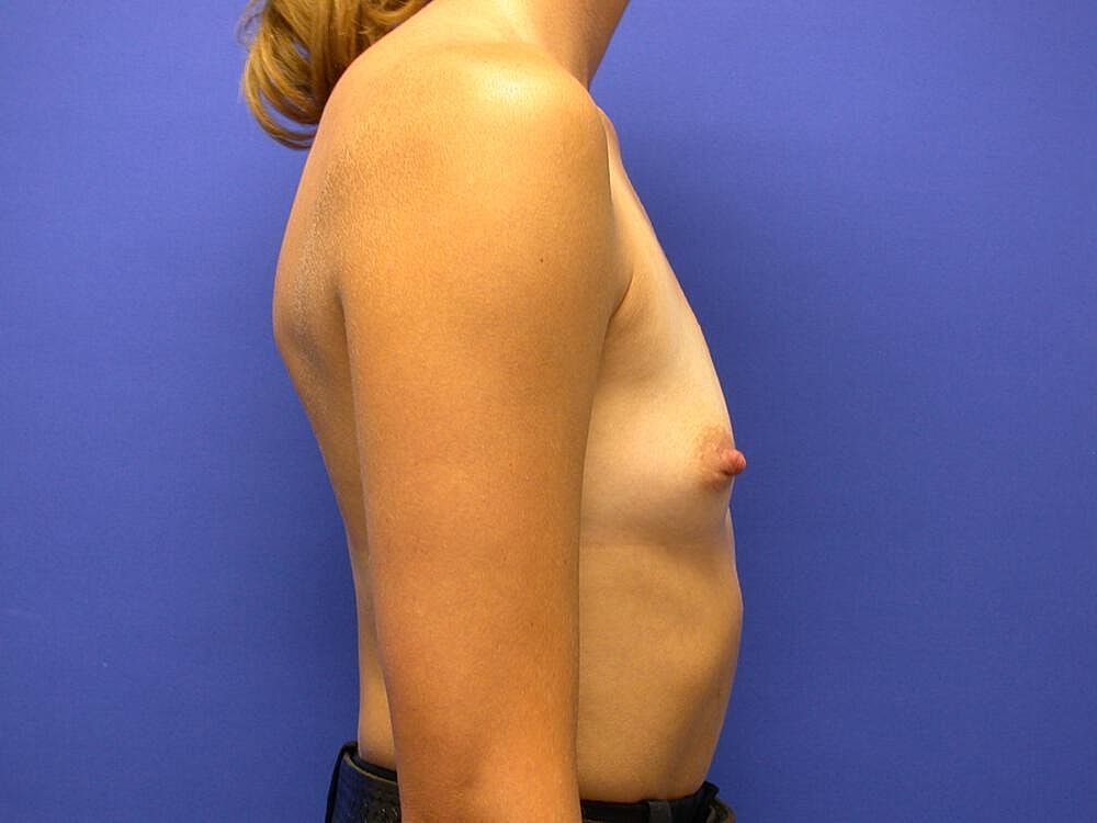 Breast Augmentation Before & After