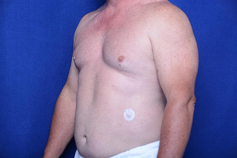 Gynecomastia Surgery Before & After