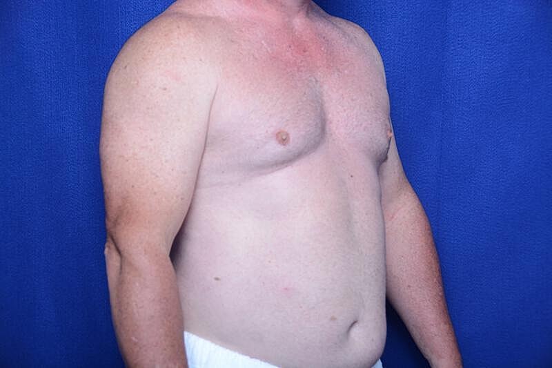 Gynecomastia Surgery Before & After