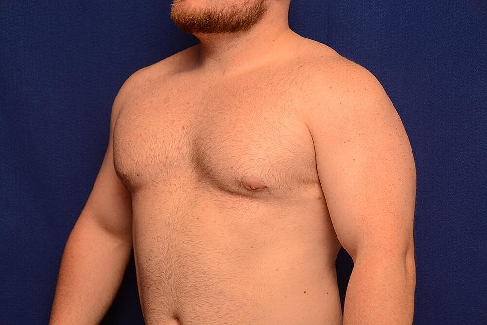 Gynecomastia Surgery Before & After
