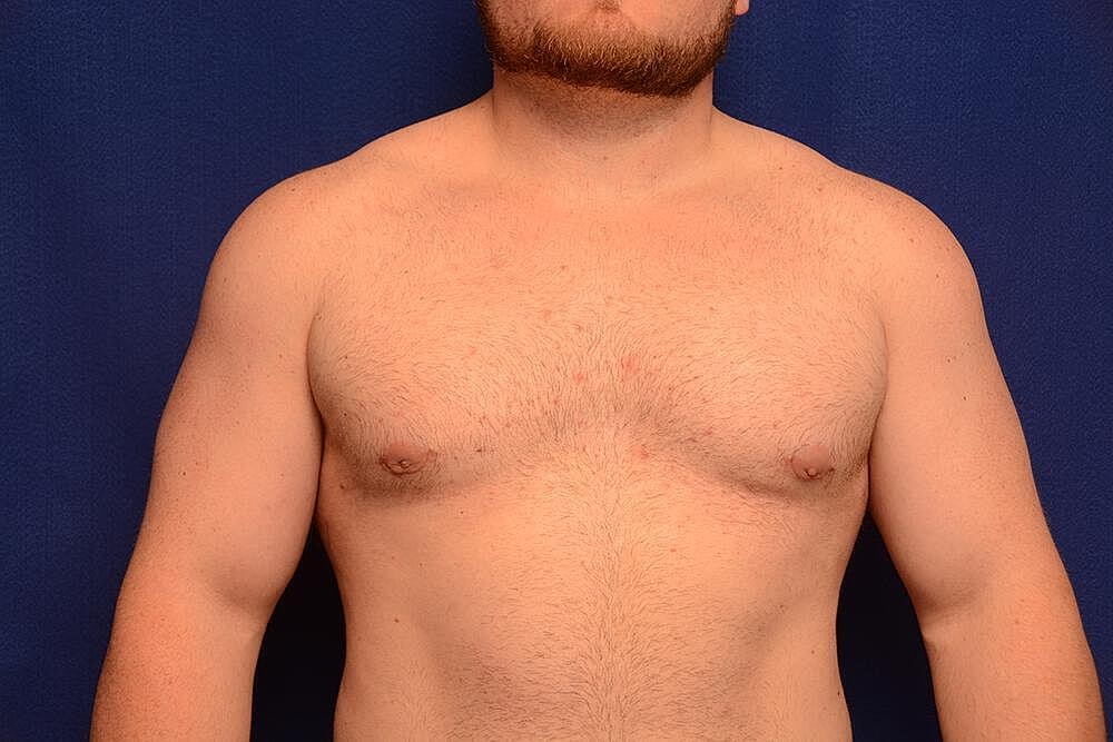 Gynecomastia Surgery Before & After