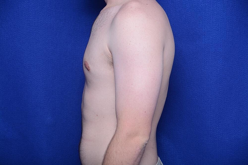 Gynecomastia Surgery Before & After