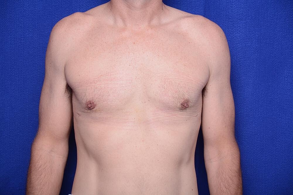 Gynecomastia Surgery Before & After