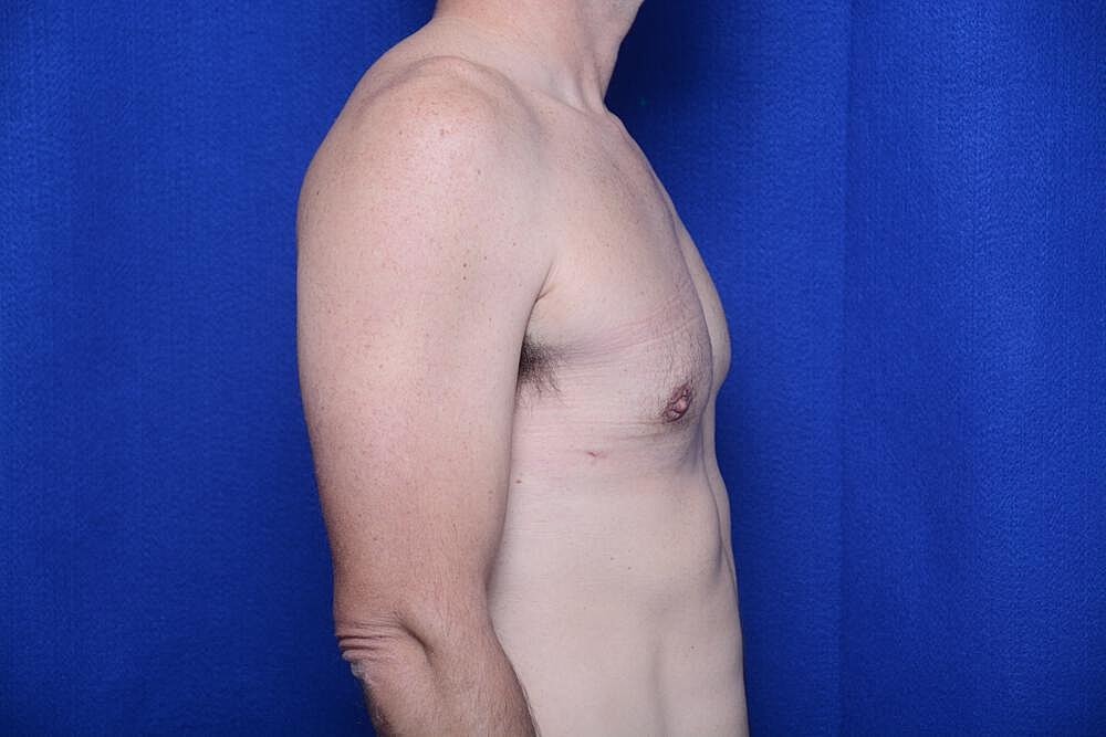 Gynecomastia Surgery Before & After