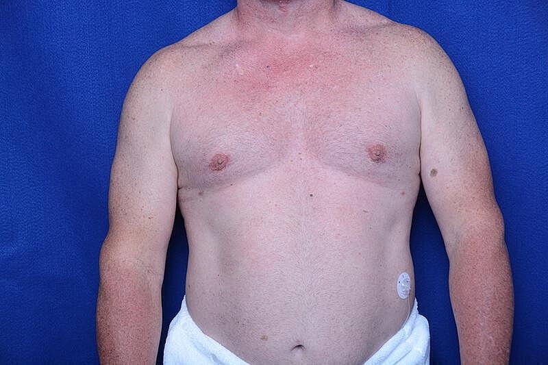 Gynecomastia Surgery Before & After