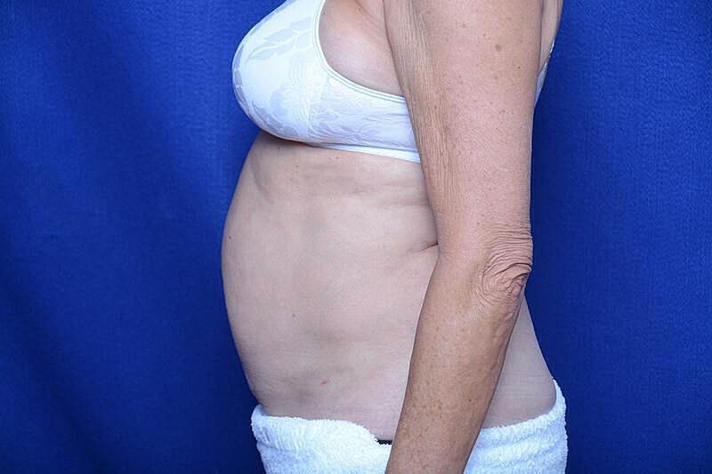 Liposuction Before & After