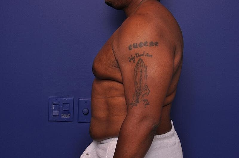 Liposuction Before & After