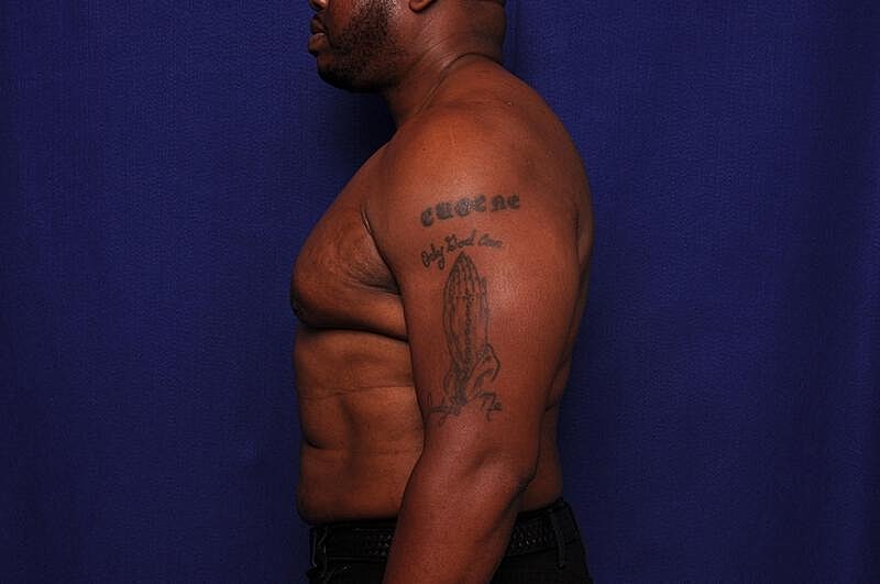 Liposuction Before & After