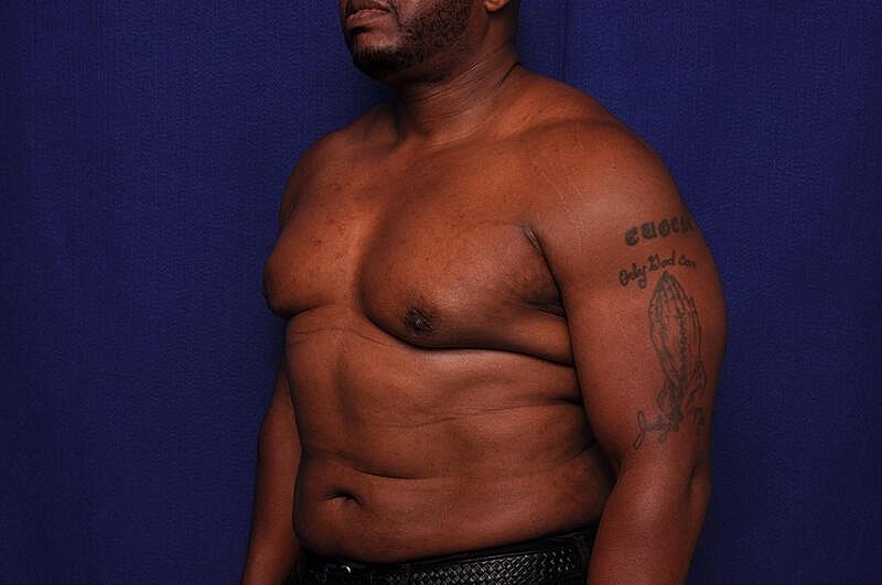 Liposuction Before & After