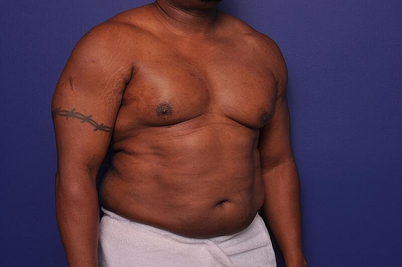 Liposuction Before & After