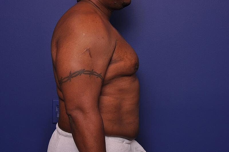 Liposuction Before & After