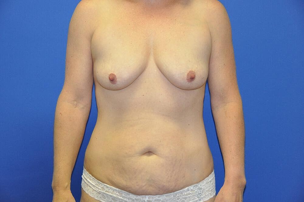 Mini Abdominoplasty Before & After