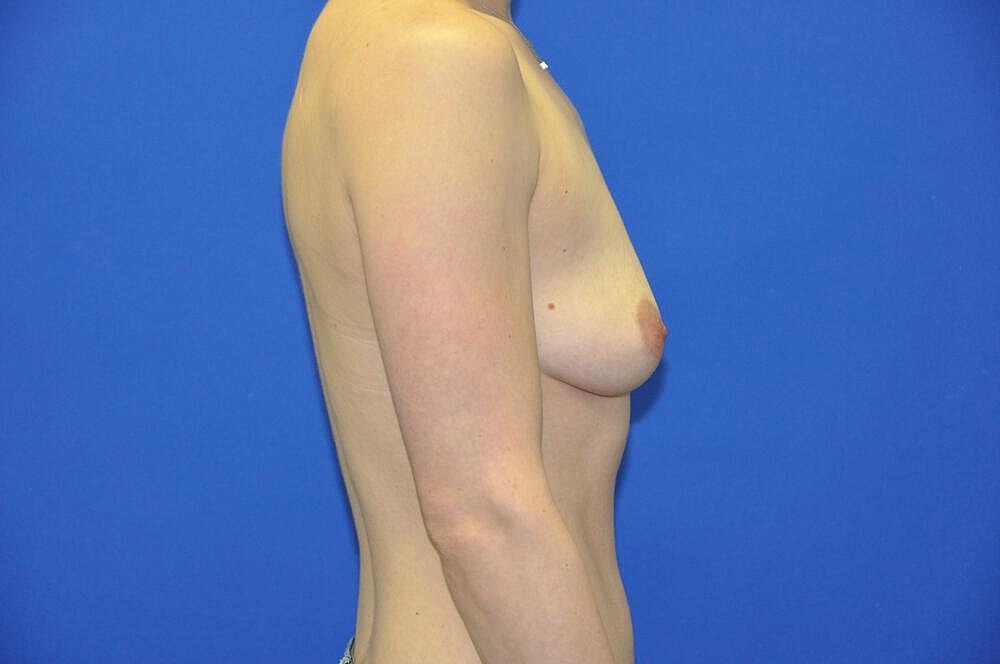 Athletic Breast Augmentation Before & After