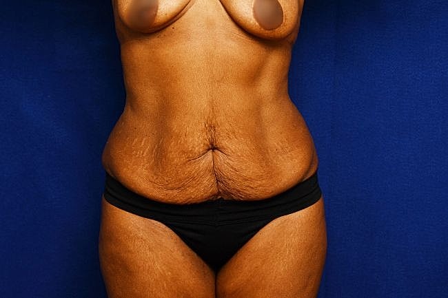 Semaglutide Before & After