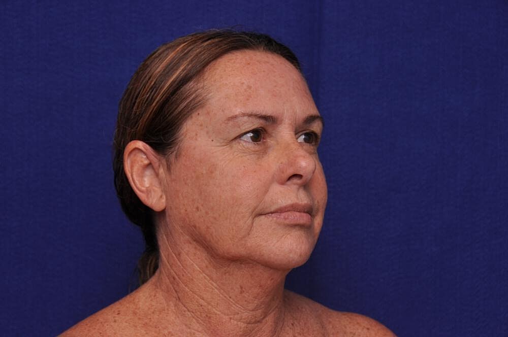 Upper Blepharoplasty Before & After