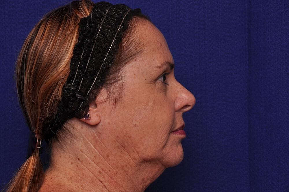 Upper Blepharoplasty Before & After