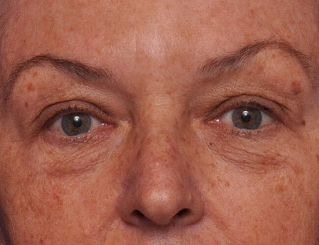 Upper Blepharoplasty Before & After
