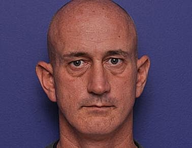 Upper Blepharoplasty Before & After