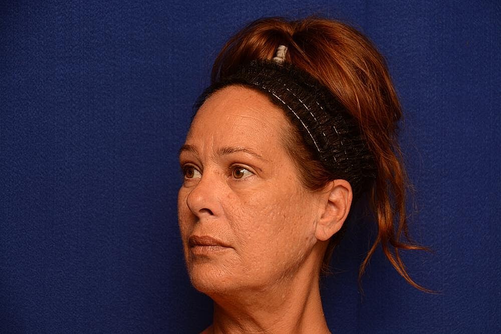 Upper Blepharoplasty Before & After