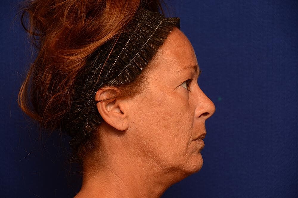 Upper Blepharoplasty Before & After