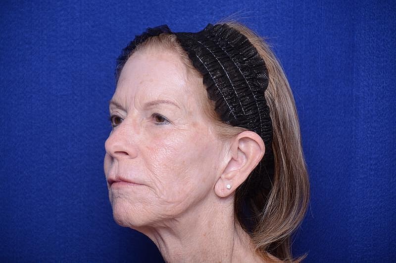 Upper Blepharoplasty Before & After