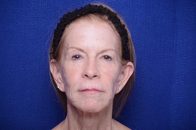 Upper Blepharoplasty Before & After