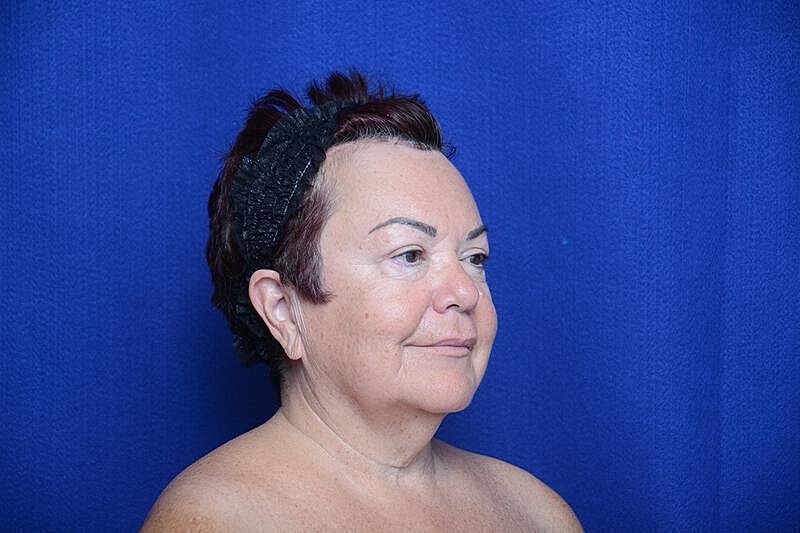 Upper Blepharoplasty Before & After