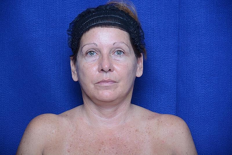 Upper Blepharoplasty Before & After