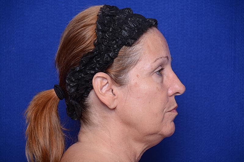 Upper Blepharoplasty Before & After