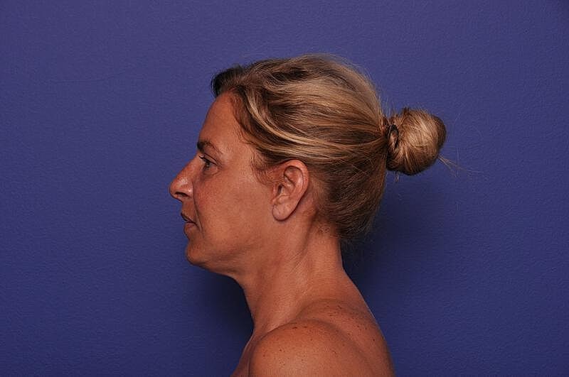 Upper Blepharoplasty Before & After