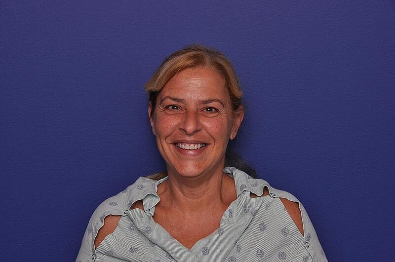 Upper Blepharoplasty Before & After