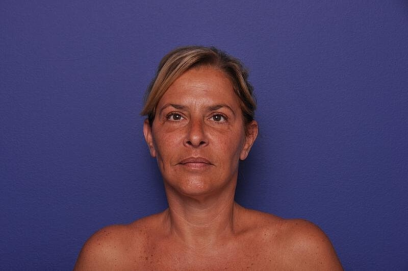 Upper Blepharoplasty Before & After