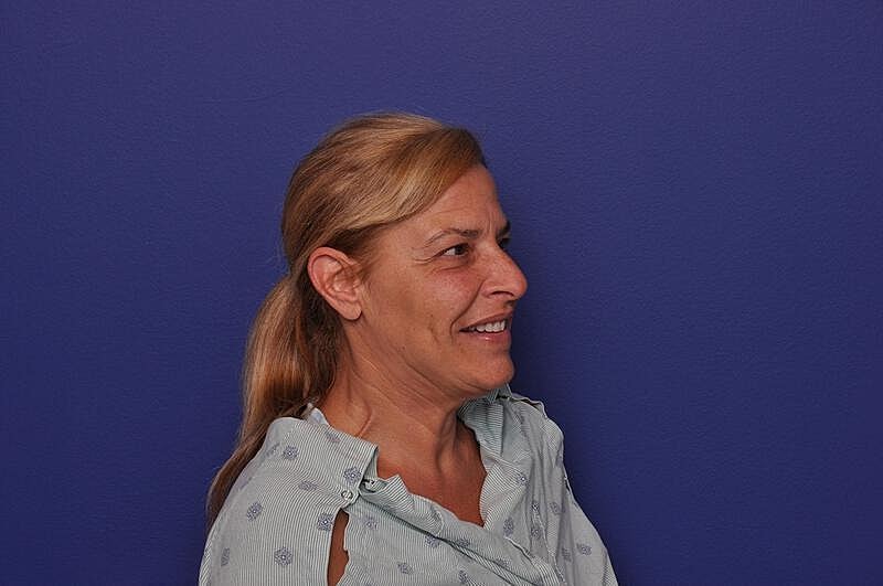 Upper Blepharoplasty Before & After