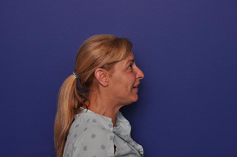 Upper Blepharoplasty Before & After