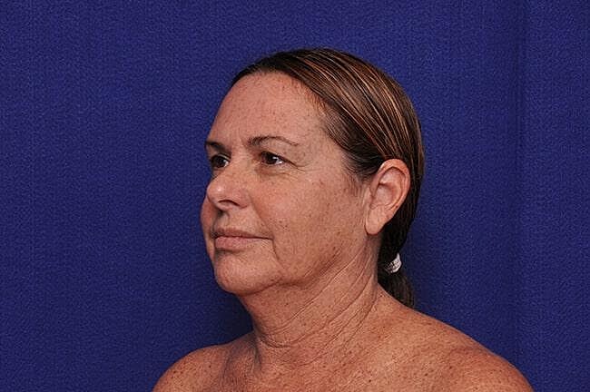 Upper Blepharoplasty Before & After