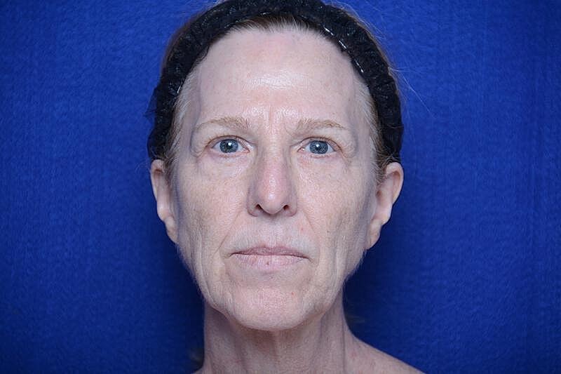 Upper Blepharoplasty Before & After