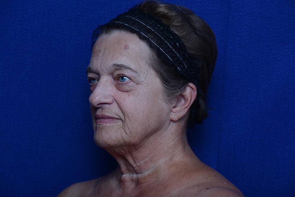 Upper Blepharoplasty Before & After