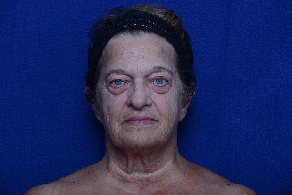 Upper Blepharoplasty Before & After