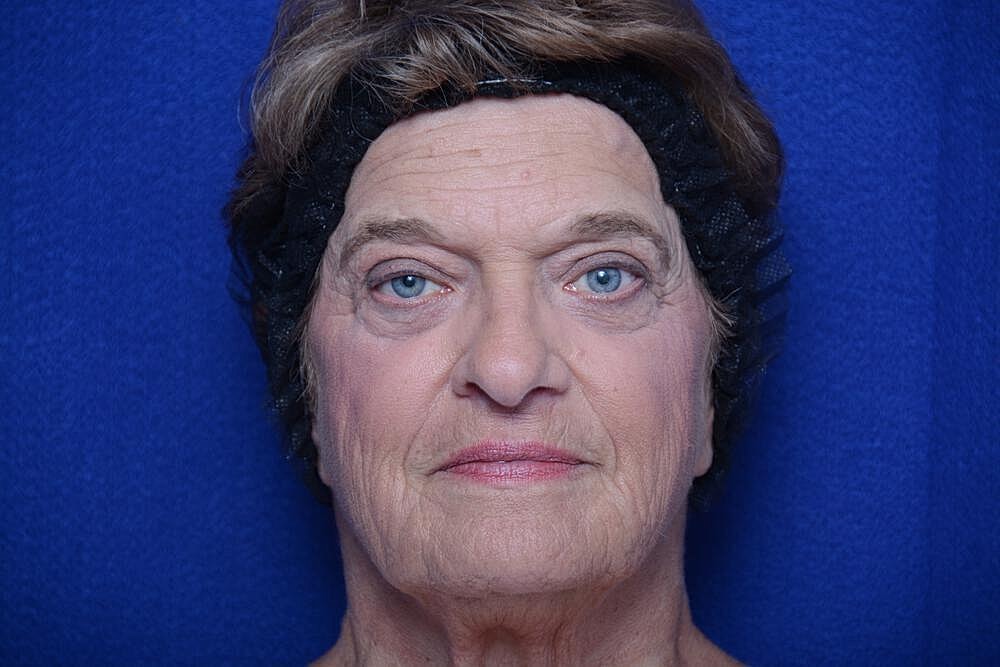 Upper Blepharoplasty Before & After