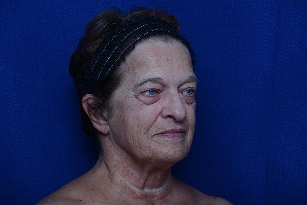 Upper Blepharoplasty Before & After