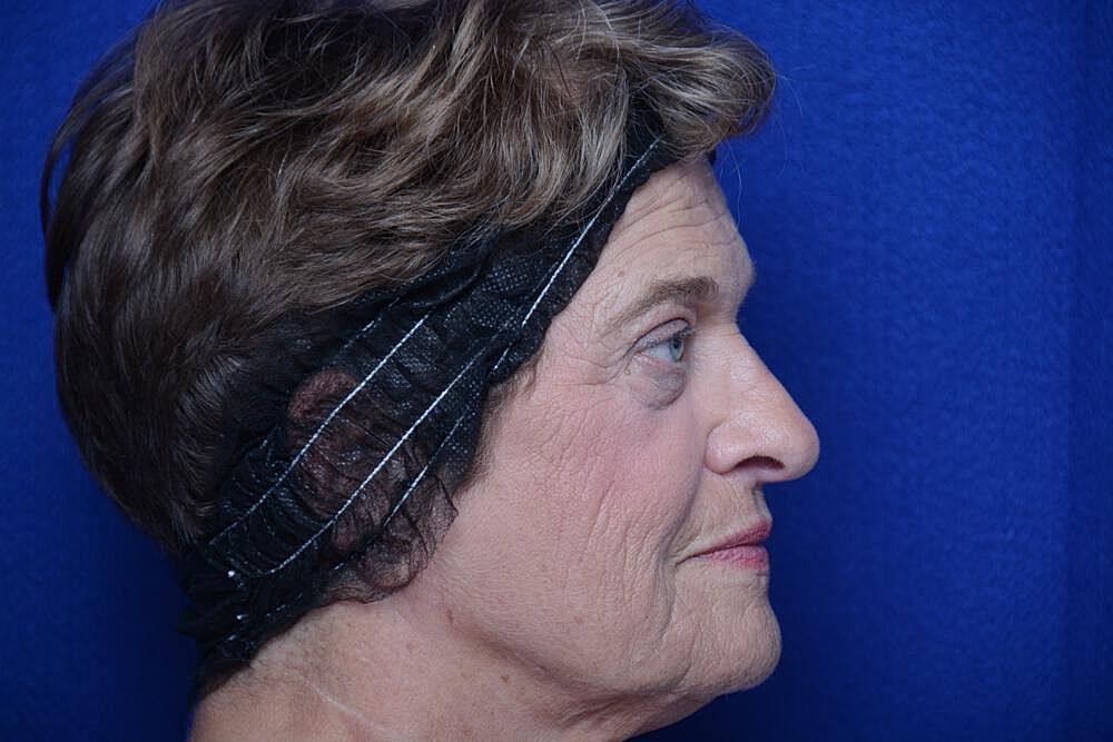 Upper Blepharoplasty Before & After