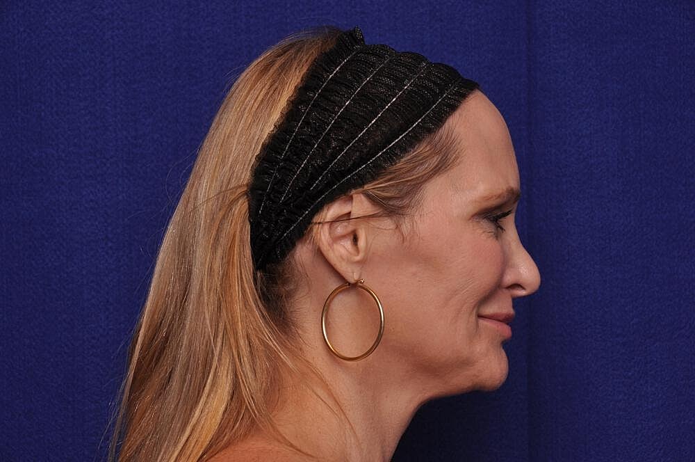 Upper Blepharoplasty Before & After