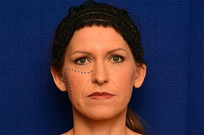 Injectable Cheek Lift Before & After