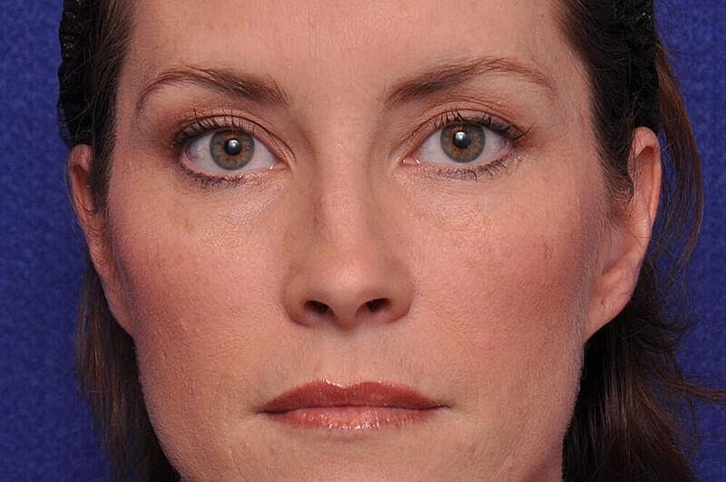 Injectable Cheek Lift Before & After