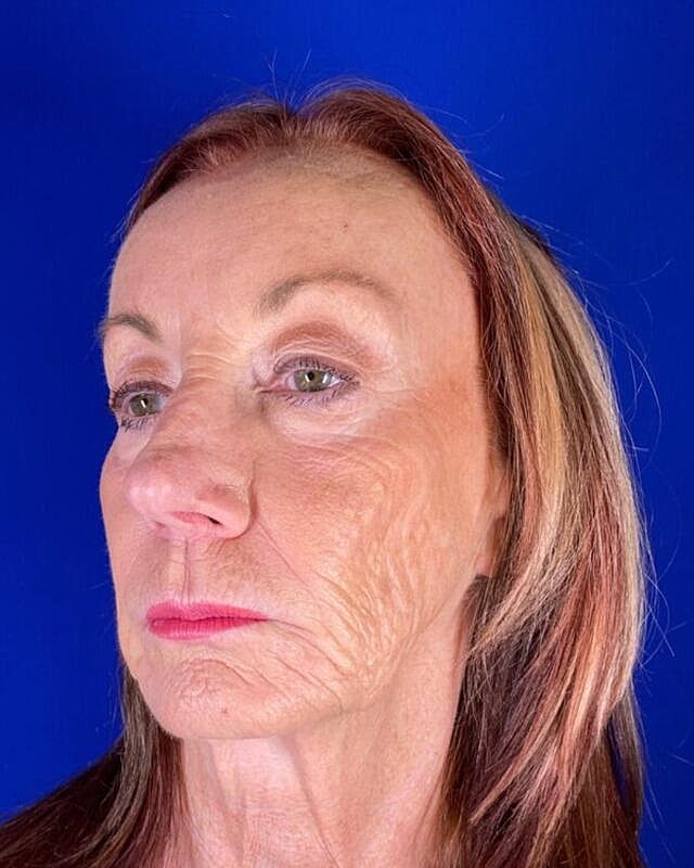 Injectable Cheek Lift Before & After