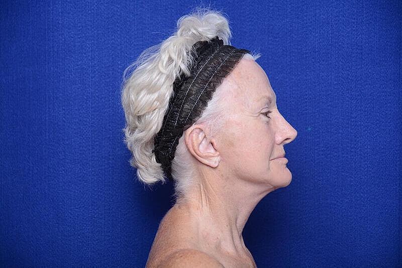 Lower Blepharoplasty Before & After