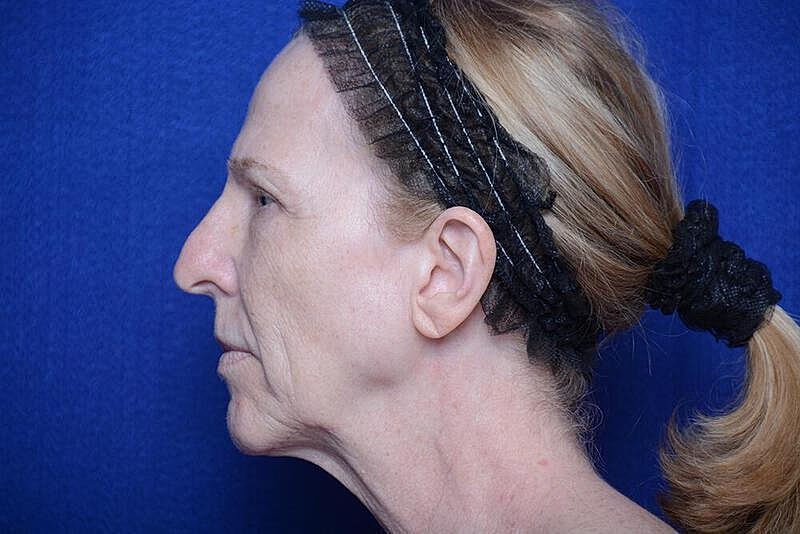 Lower Blepharoplasty Before & After