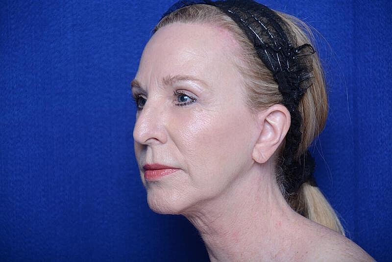 Lower Blepharoplasty Before & After